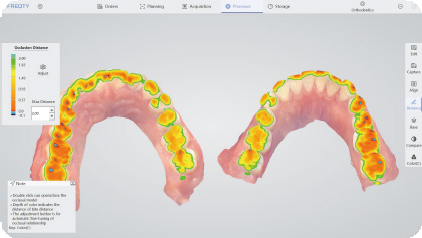 intraoral scanners in dentistry，3d intraoral scanner，dental intraoral scanner，digital scanner dental，digital intraoral scann，dental impression scanner，mouth scan，dental 3d scanner price，dental scanning machie，3d mouth scan