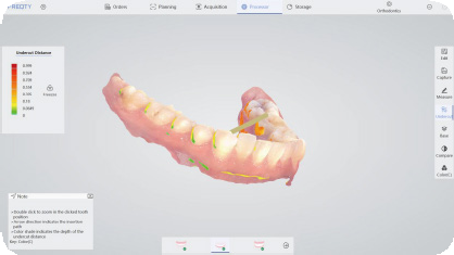 intraoral scanners in dentistry，3d intraoral scanner，dental intraoral scanner，digital scanner dental，digital intraoral scann，dental impression scanner，mouth scan，dental 3d scanner price，dental scanning machie，3d mouth scan